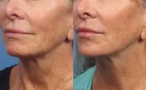 How Dermal Fillers in Scottsdale Enhance Natural Facial Rejuvenation